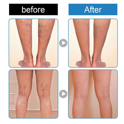 Spray for Varicose Veins
