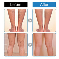 Spray for Varicose Veins