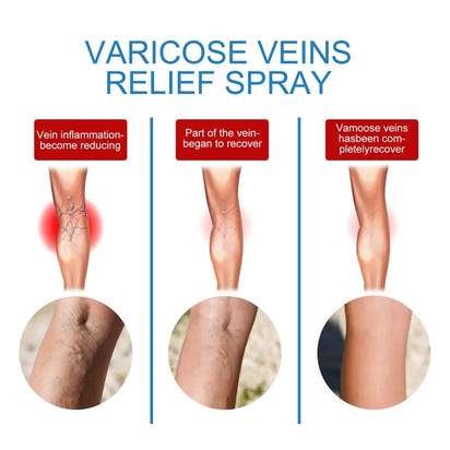 Spray for Varicose Veins