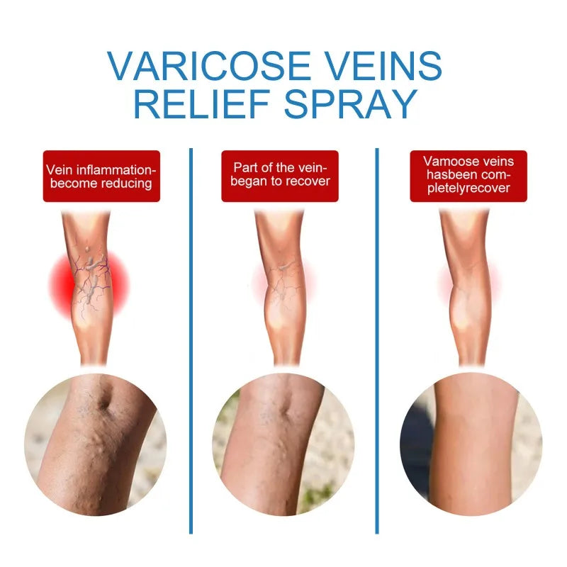 Spray for Varicose Veins