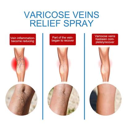 Spray for Varicose Veins