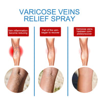 Spray for Varicose Veins