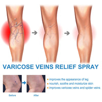 VARICOSE™ VEINS RELIEF
